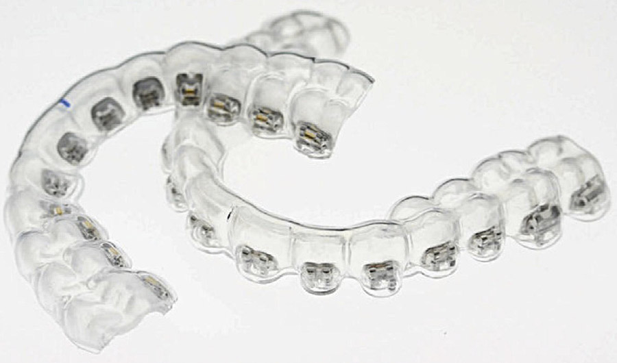 Invisalign ou Lingual, quel traitement choisir