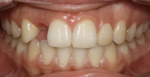 ouverture d'un espace prothétique