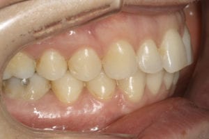 après chirurgie : plus aucun décalage