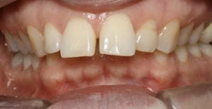 dents du haut en avant