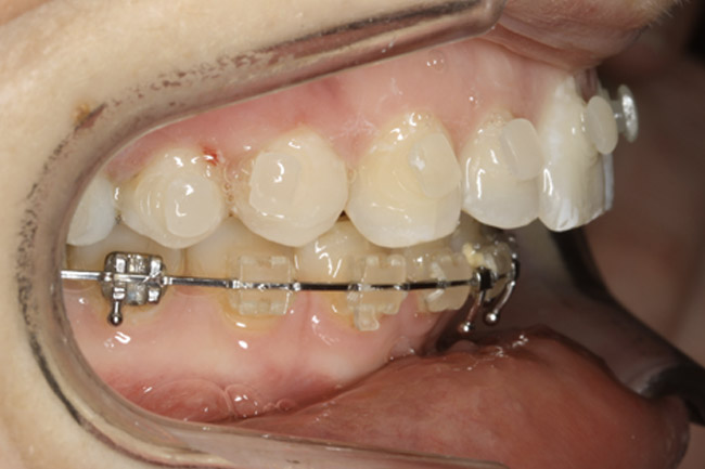 orthodontie avant chirurigie