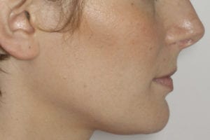 profil après chirurgie et orthodontie