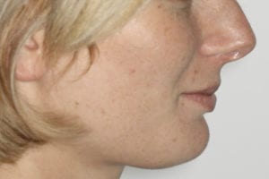 profil avant orthodontie et chirurgie