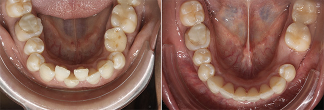 Alignements des dents avec des gouttières transparentes Rungis