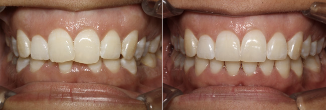 Invisalign alignement avant/après 