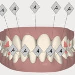 alignement haut bas Invisalign