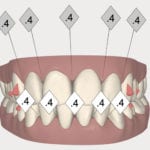 alignement haut bas Invisalign