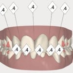 début traitement Invisalign