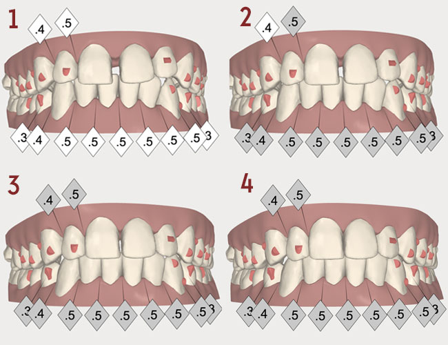 Fermeture des dents du bonheur avec Invisalign