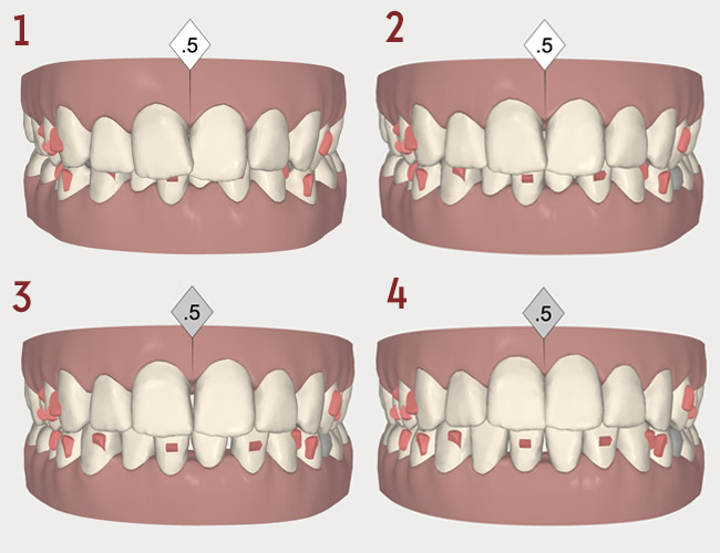 réduction du recouvrement -Invisalign