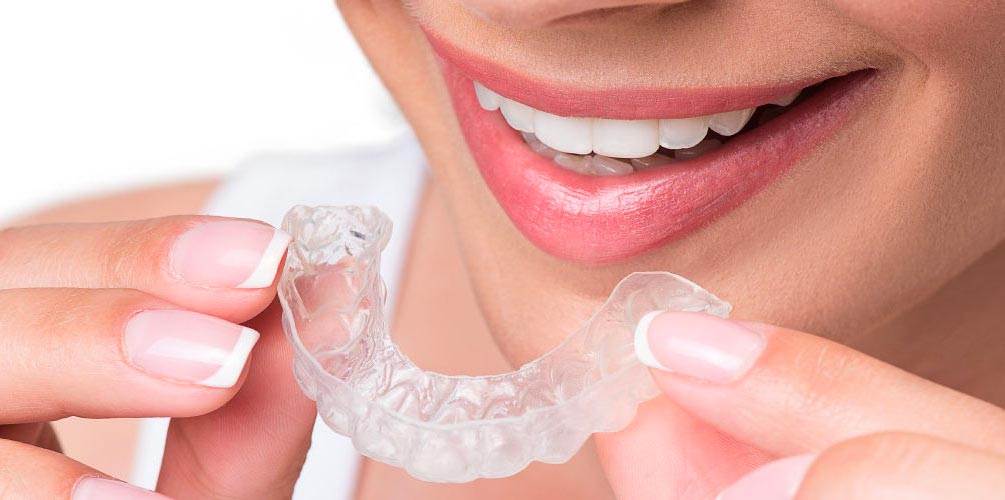 gouttière de la mâchoire supérieur appareil invisalign