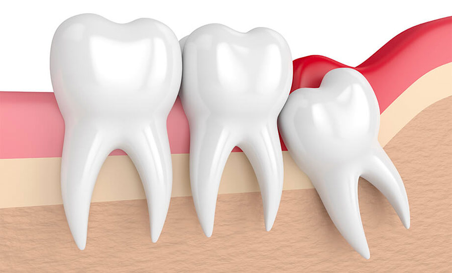 dents de sagesse et récidive 