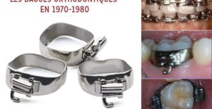 bagues orthodontiques en 1970-1980