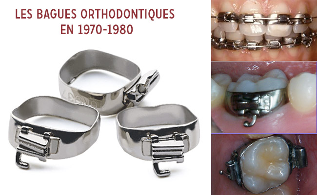 bagues orthodontiques en 1970-1980