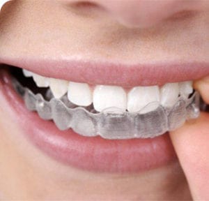 Traitement orthodontique amovible Invasilign