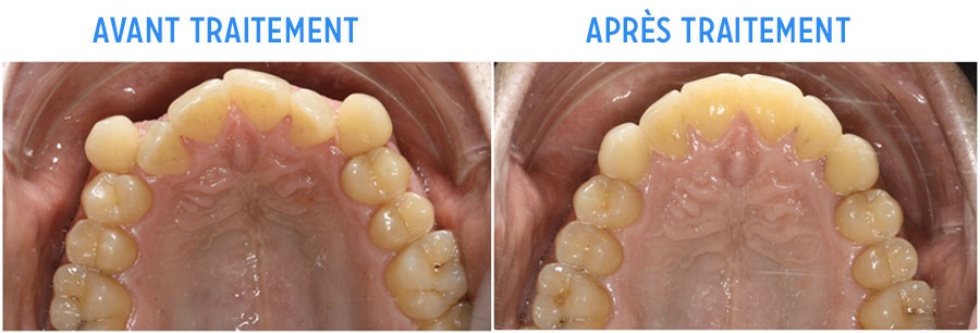 Orthodontie adulte avant/après traitement d'un mauvais alignement des dents du haut
