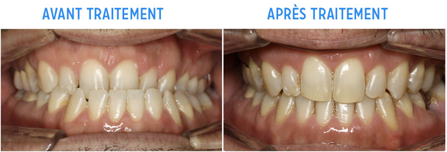 adulte orthodontie avant/après cas d'occlusion croisée