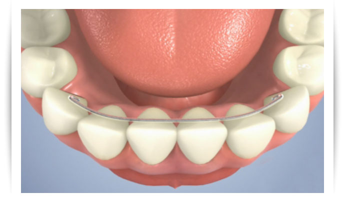 fil de contention en orthodontie