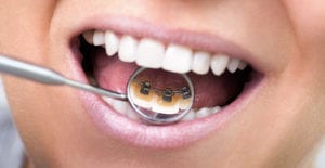 traitement en lingual chez l'adulte