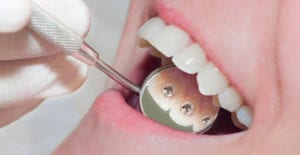 appareil lingual sur un homme