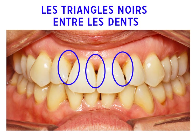 Tartre dentaire : comment s'en débarrasser soi-même ?