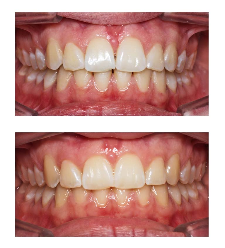 suppression des triangles noirs grâce à l'orthodontie