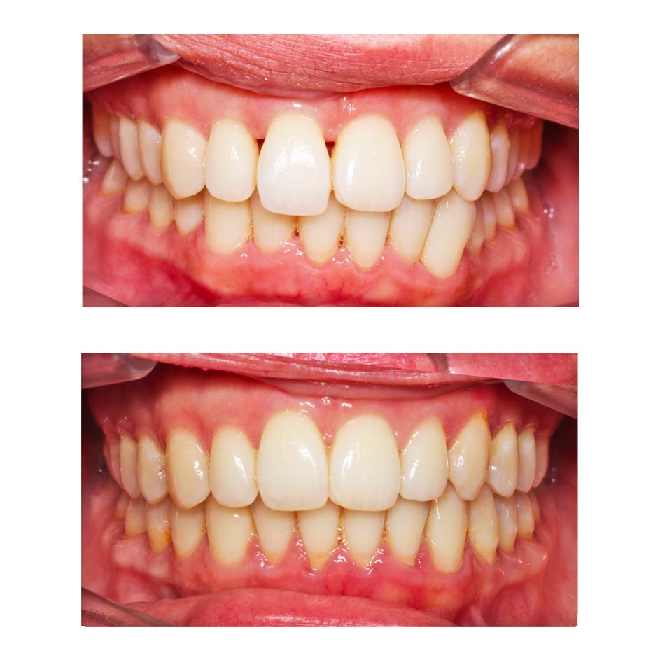 Triangles noirs sur les dents et orthodontie