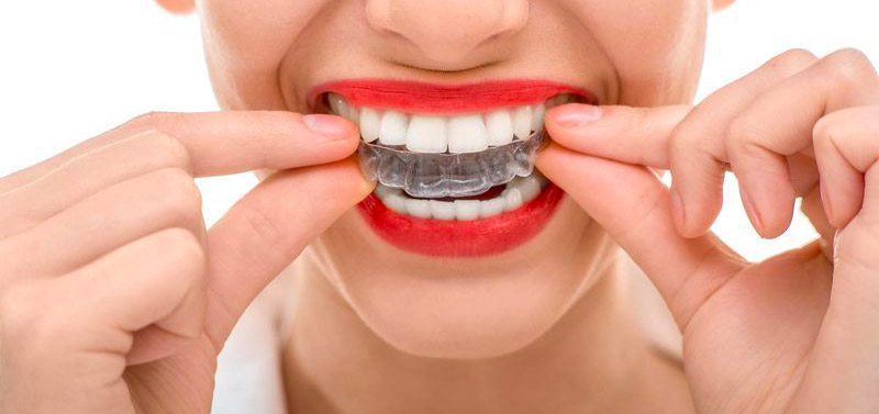 appareil Invisalign précautions