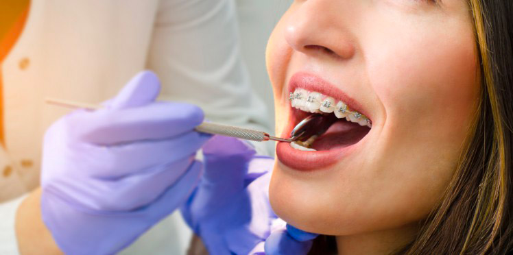 orthodontie à l'âge adulte