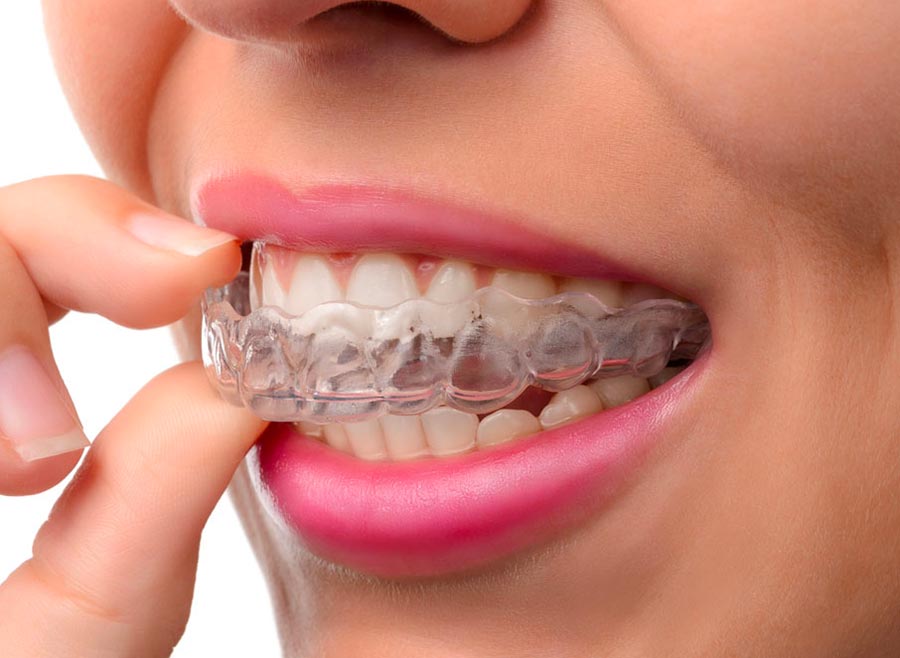 L'orthodontie invisible pour les adolescents, enfin une réalité