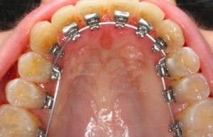 bagues linguales en bas