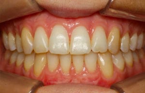 bagues linguales de face invisible