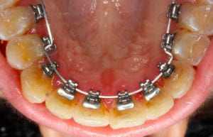 bagues linguales en haut