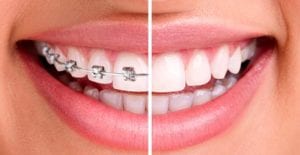 orthodontie visible ou invisible