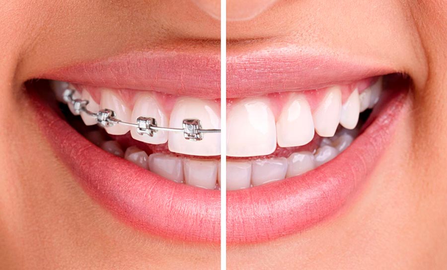 Invisalign : Orthodontie et appareil dentaire invisible - GUIDE