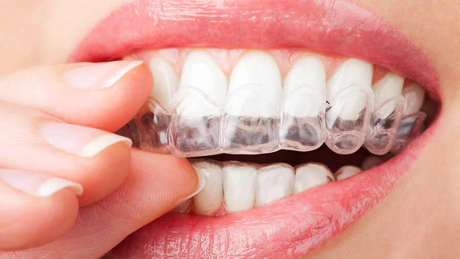 gouttières dentaires Invisalign