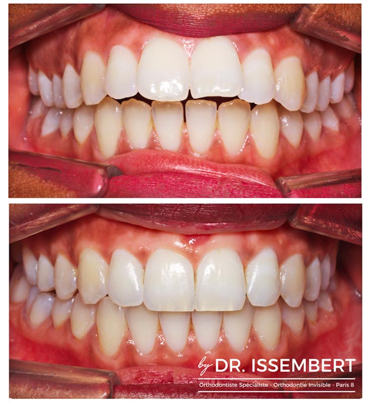 ORTHODONTIE DE L'ADULTE : TECHNIQUE PAR ALIGNEURS (GOUTTIÈRES TRANSPARENTES)