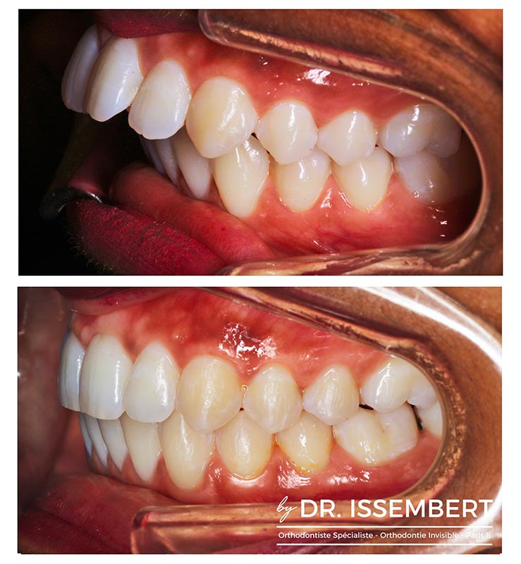 Invisalign avant après, vue de profil