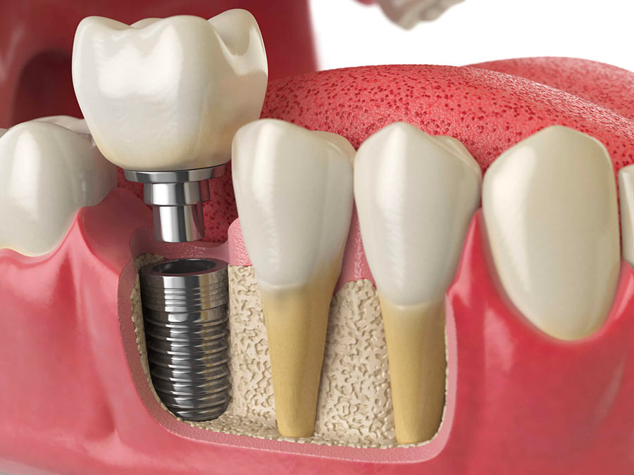 Pose d'implant et traitement Invisalign