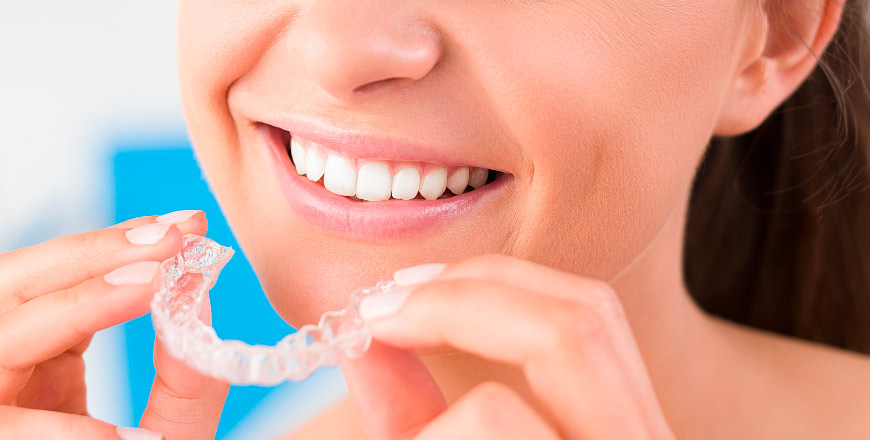 gouttière Iinvisalign sur le maxillaire (mâchoire supérieure)