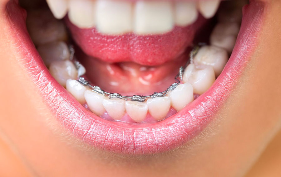 traitement d'orthodontie avec des bagues linguales