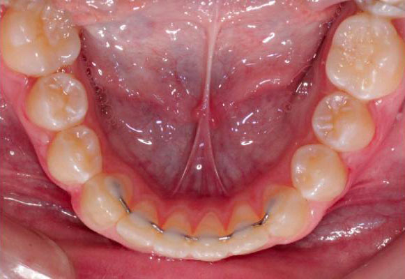contention fil sur la face interne des dents