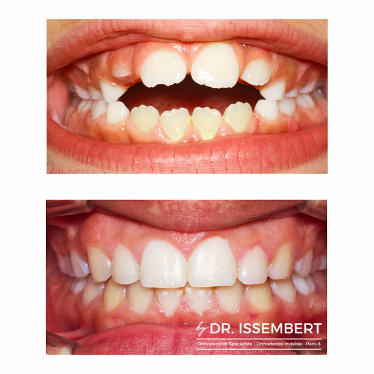 Invisalign Paris 8è Appareil Orthodontique par gouttières transparentes
