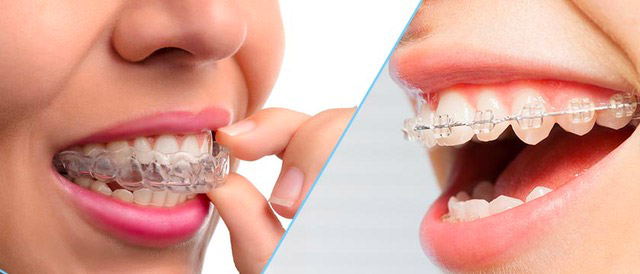 Invisalign ou bagues ?