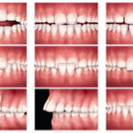 malocclusions-orthodontie