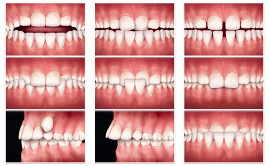 malocclusions-orthodontie