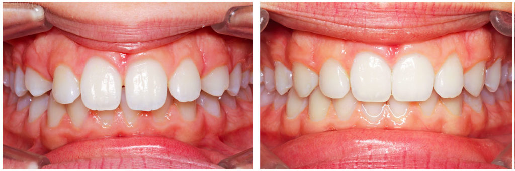 avant-apres-dents-bonheur-appareil-invisalign