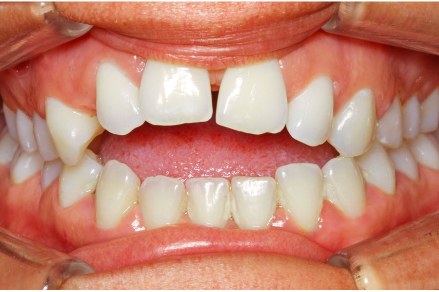 avant-traitement-lingual-dents-bonheur