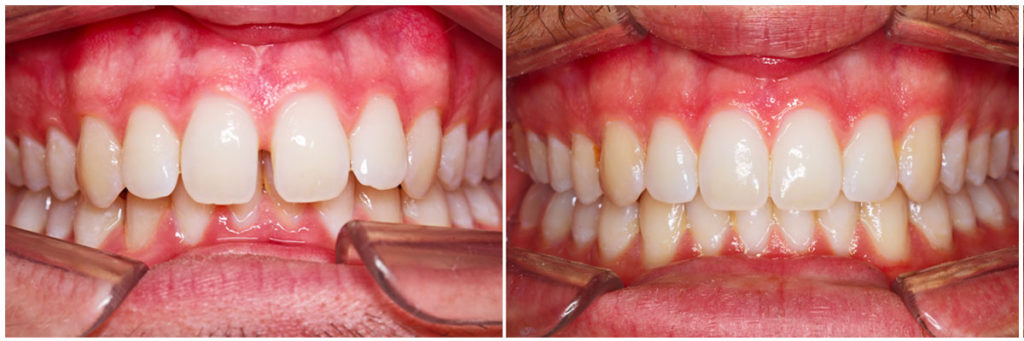 dents-du-bonheur-avant-apres-invisalign