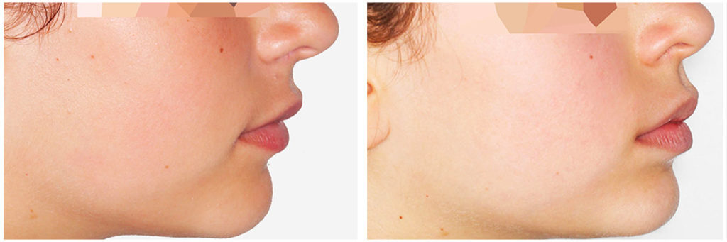 profil-avant-apres-invisalign-dents-bonheur